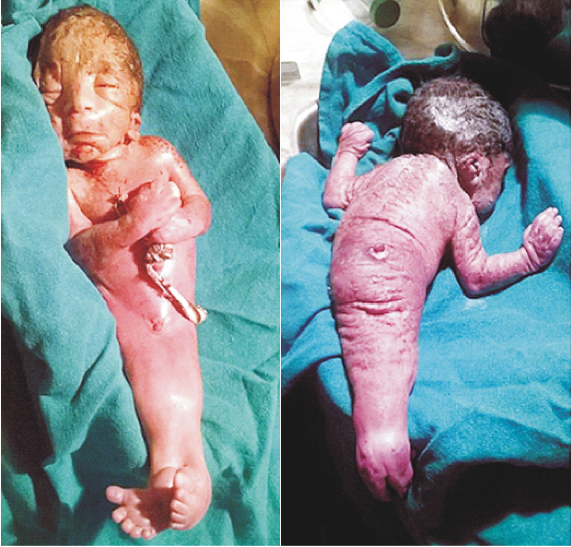 Baby born with both legs joined together in womb - PH Spectator